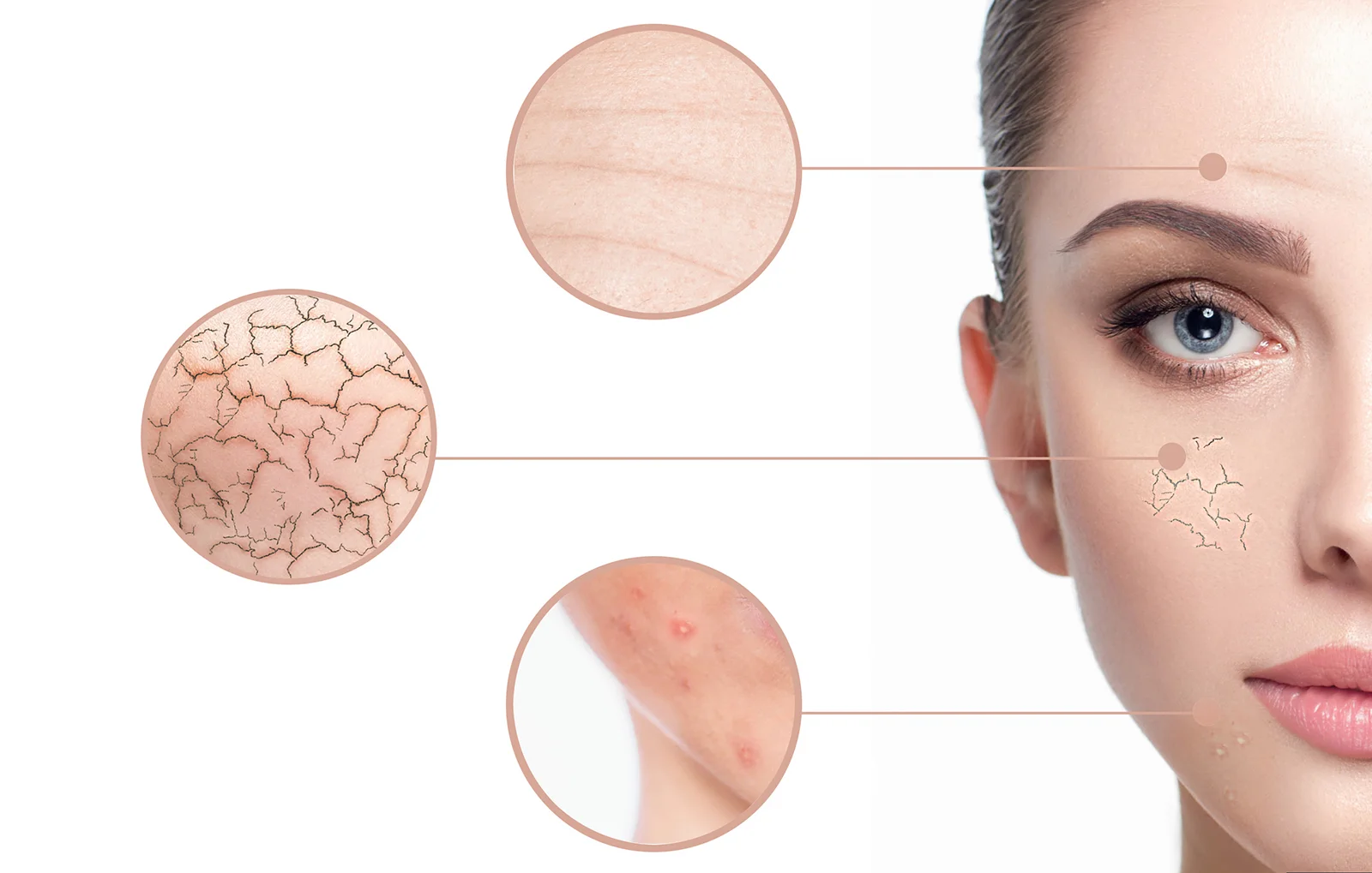 Close-up illustration of acne-prone skin with dryness, irritation, and blemishes highlighted — ORY Skincare solutions for breakout-prone complexions.