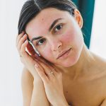 Woman with acne-prone, irritated skin preparing to apply soothing balancing toner — ORY Skincare toner for acne-prone skin.